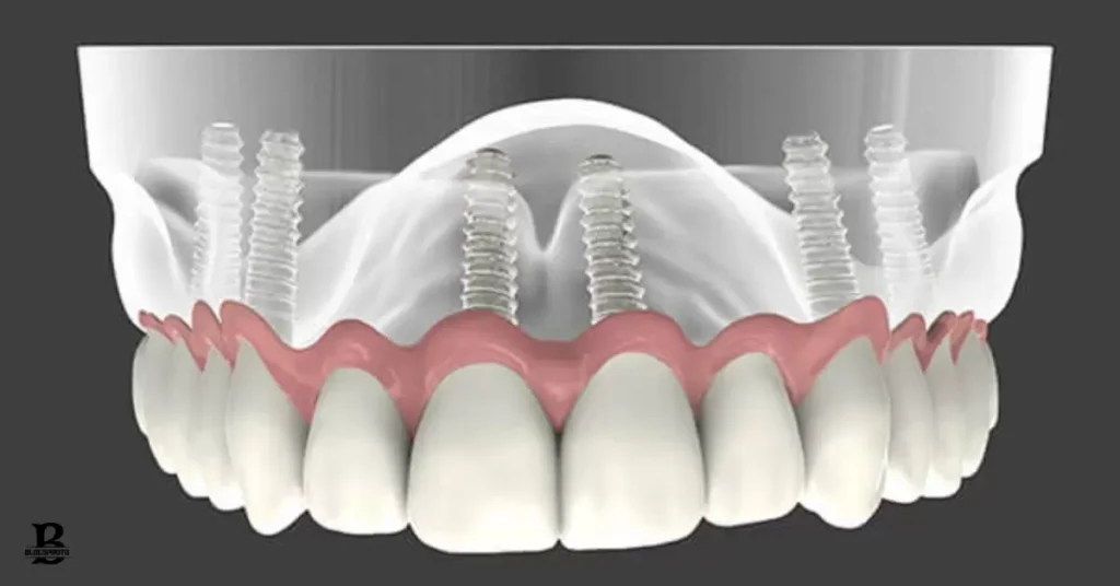 Alternatives to $399 dental implants